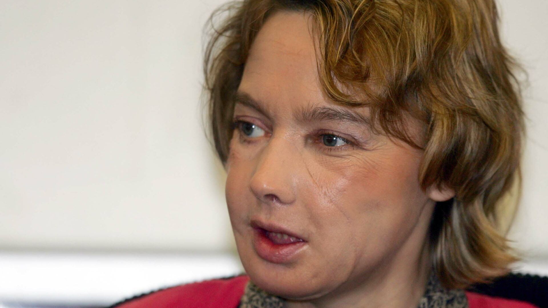 Isabelle Dinoire, la primera persona en recibir un trasplante de cara, marcó un antes y un después en la historia de la medicina reconstructiva (AFP)