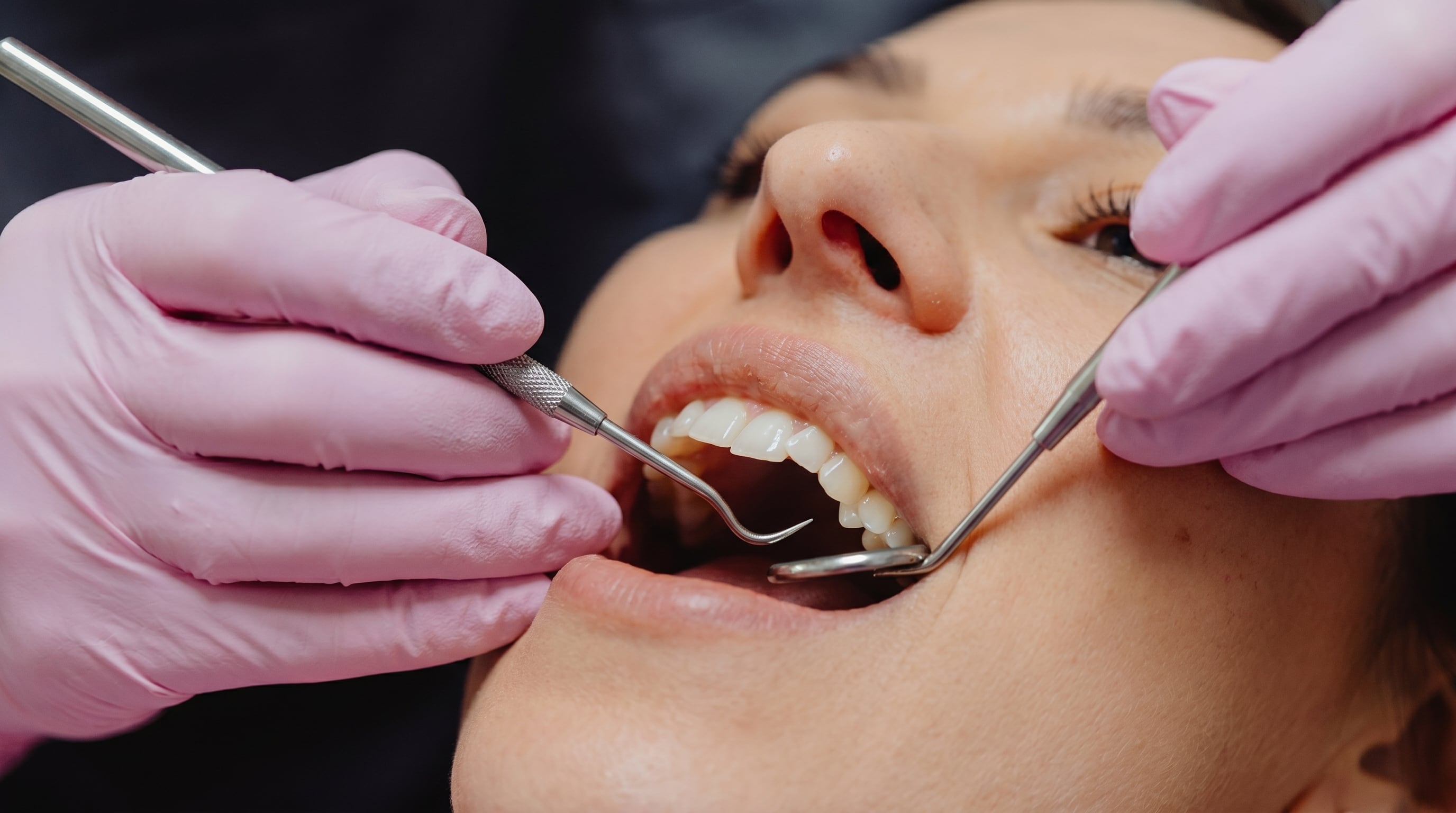 Dos manos con guantes rosados manipulan instrumentos odontológicos dentro de la boca abierta de un paciente durante una revisión dental. (Imagen Ilustrativa Infobae)