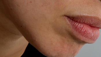 ¿Por qué la rosácea empeora