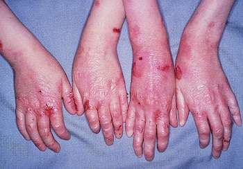 La epidermólisis ampollosa (EB) es