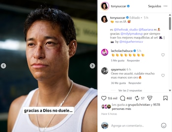 Primer plano de un hombre con el pelo corto y piel morena que luce un moretón en la mejilla izquierda y una herida en la nariz
