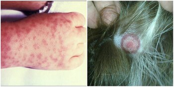 Algunos síntomas es fiebre, dolores