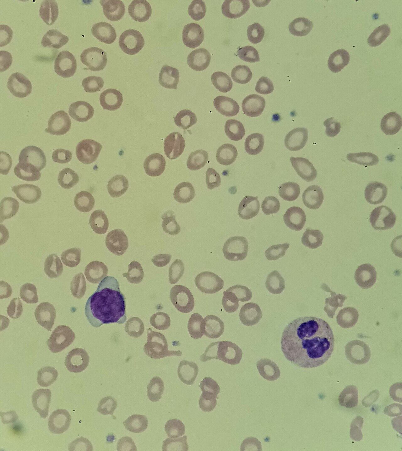 Frotis de sangre que muestra anemia hipocrómica (y microcítica ). Obsérvese el aumento de la palidez central de los glóbulos rojos (Wikimedia)