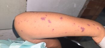 Según la OMS, las infecciones