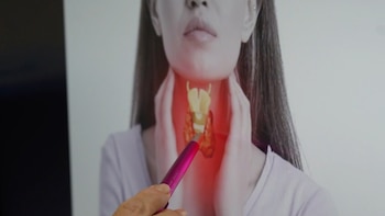 Enfermedades de la tiroides afectan más a mujeres: advierten que el 10% de los nódulos pueden ser cancerígenos