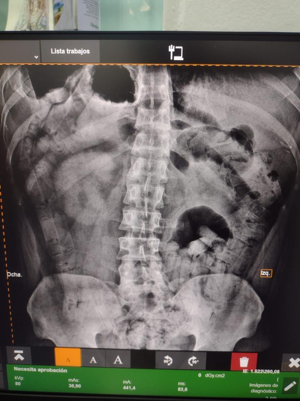 La Policía Metropolitana de Tokio derivó a la argentina a un hospital donde le hicieron una placa de rayos X y descubrieron el cargamento en su cuerpo (Foto/Imagen ilustrativa de Infobae)
