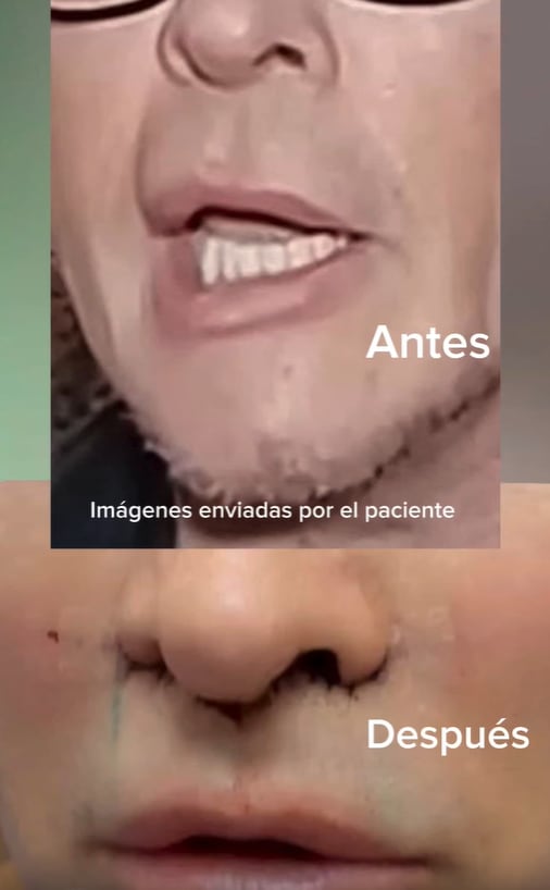 El resultado de la intervención estética a la que se sometió Süller (Captura de video)