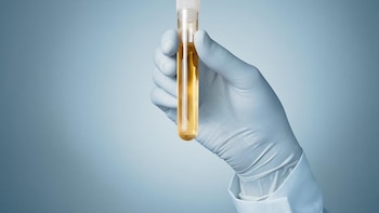 Estudio indica que una prueba de orina puede detectar autismo