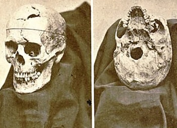 Phineas Gage sobrevivió casi 12