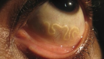 El gusano que cruza tu ojo: qué es y cómo se mueve por el cuerpo humano