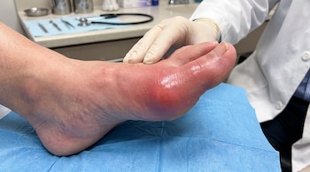 Primer plano de un pie con el dedo gordo hinchado y enrojecido sobre una tela azul, con una mano enguantada de médico y parte de un consultorio al fondo.