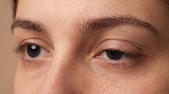 Primer plano de ojos de una persona; el párpado superior del ojo derecho está parcialmente caído, el ojo izquierdo está abierto, con cejas y piel del rostro.