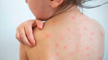 La vacunación es la principal medida para prevenir la enfermedad, por lo que el Minsa exhorta a los padres y cuidadores a verificar las dos dosis de los menores y acudir a los establecimientos de salud para completar el esquema - Créditos: Andina.
