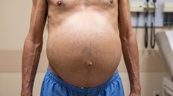 El torso de una persona muestra un abdomen distendido con estrías. Al fondo, se ven instrumentos médicos desenfocados.