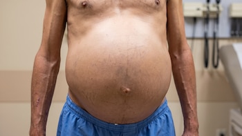 Cómo luce el abdomen de una persona que padece hígado graso en primeras y últimas etapas