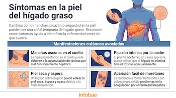 Infografía con título 'Síntomas en la piel del hígado graso'. Ilustración de torso humano, hígado, manchas en cuello, piel seca, brazo con rasguños y moretones en pierna. Logo Infobae.