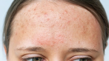 Las directrices incluyen lo que la AAD denominó recomendaciones “condicionales”, que deben ser consideradas por los médicos caso por caso: Uso de cremas de clascoterona, que se enfocan en problemas hormonales que podrían provocar acné