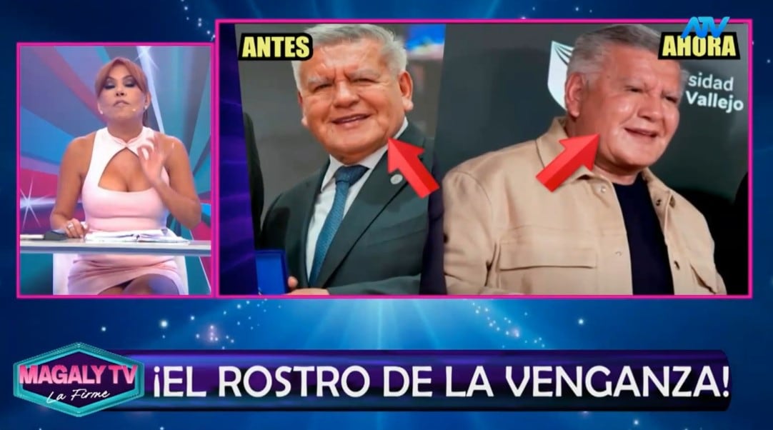 ¿Qué se habría hecho César Acuña en el rostro? Magaly Medina reacciona y especialistas analizan su apariencia. Captura: Magaly TV La Firme.