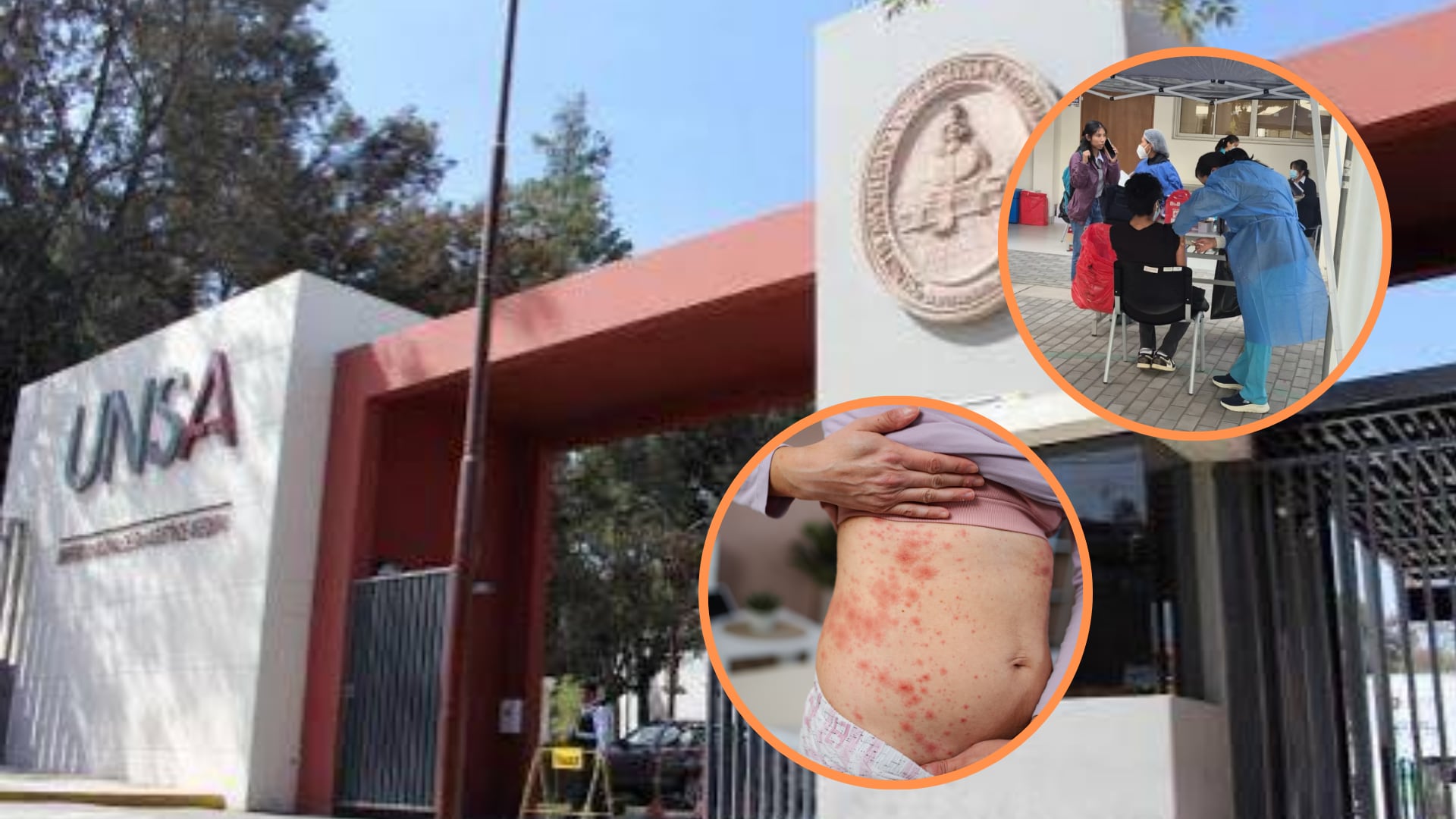 Confirmaron el primer caso de sarampión en Arequipa en una estudiante de la Escuela Profesional de Contabilidad de la UNSA. Composición: Infobae