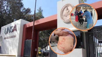 UNSA suspende actividades presenciales luego de confirmarse el primer caso de sarampión en Arequipa en estudiante universitaria