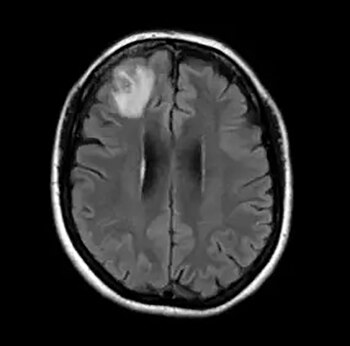 La infección puede ser causada