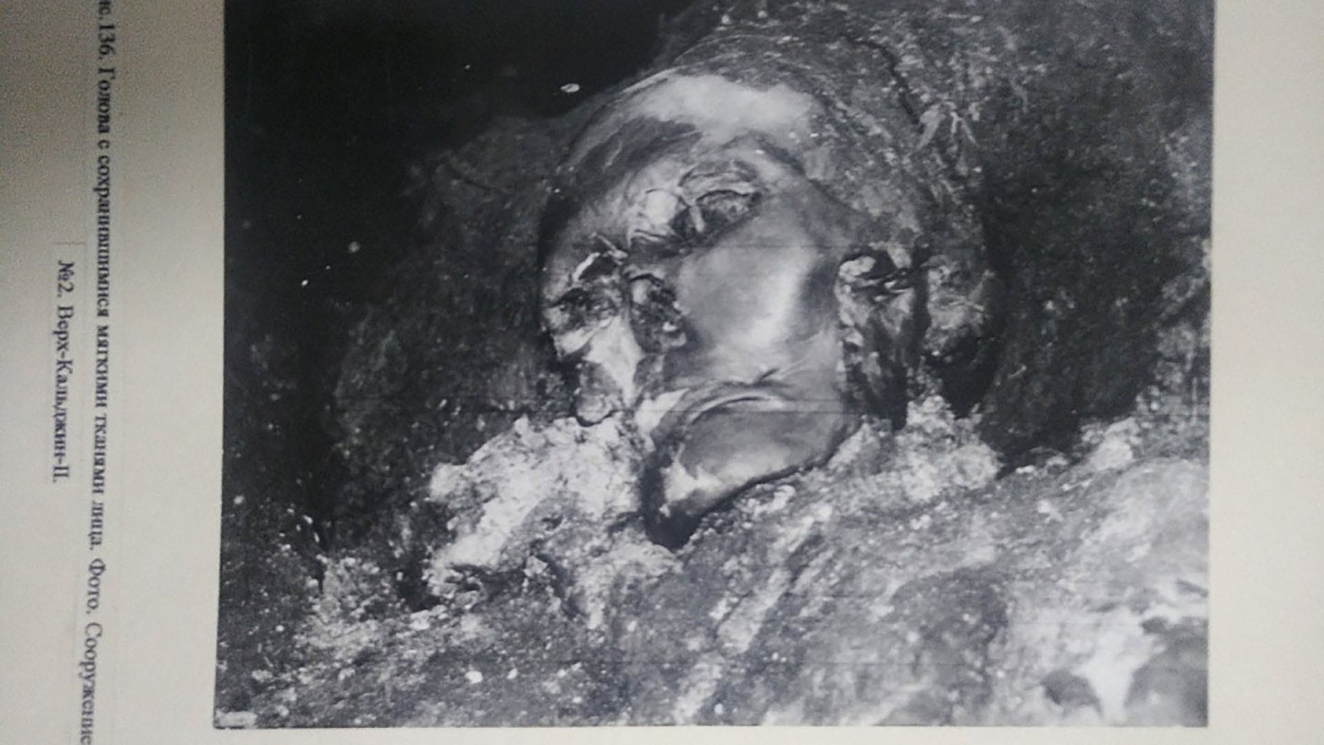 La paciente, de entre 25 y 30 años, sufrió una fractura grave que afectó la articulación temporomandibular ( Universidad Estatal de Novosibirsk)