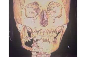 Representación 3D de un cráneo humano de color dorado sobre un fondo oscuro, mostrando claramente la mandíbula y el hueso frontal