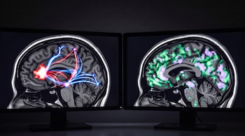Dos monitores de computadora muestran imágenes de resonancia magnética de un cerebro humano. Una imagen tiene áreas rojas y líneas de colores, la otra tiene áreas verdes y moradas.