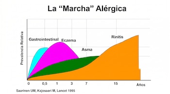 Gráfico de prevalencia relativa de alergias por edad: gastrointestinal (cian), eccema (magenta), asma (verde), rinitis (naranja). Fuente: Lancet 1995.