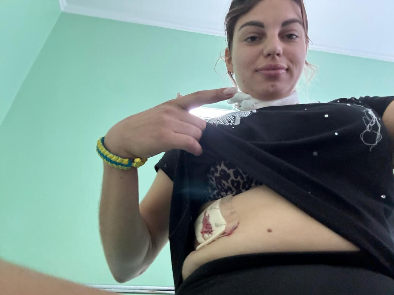 Anastasia Pavlenko muestra su estómago herido. (Foto del archivo personal de Anastasia Pavlenko)