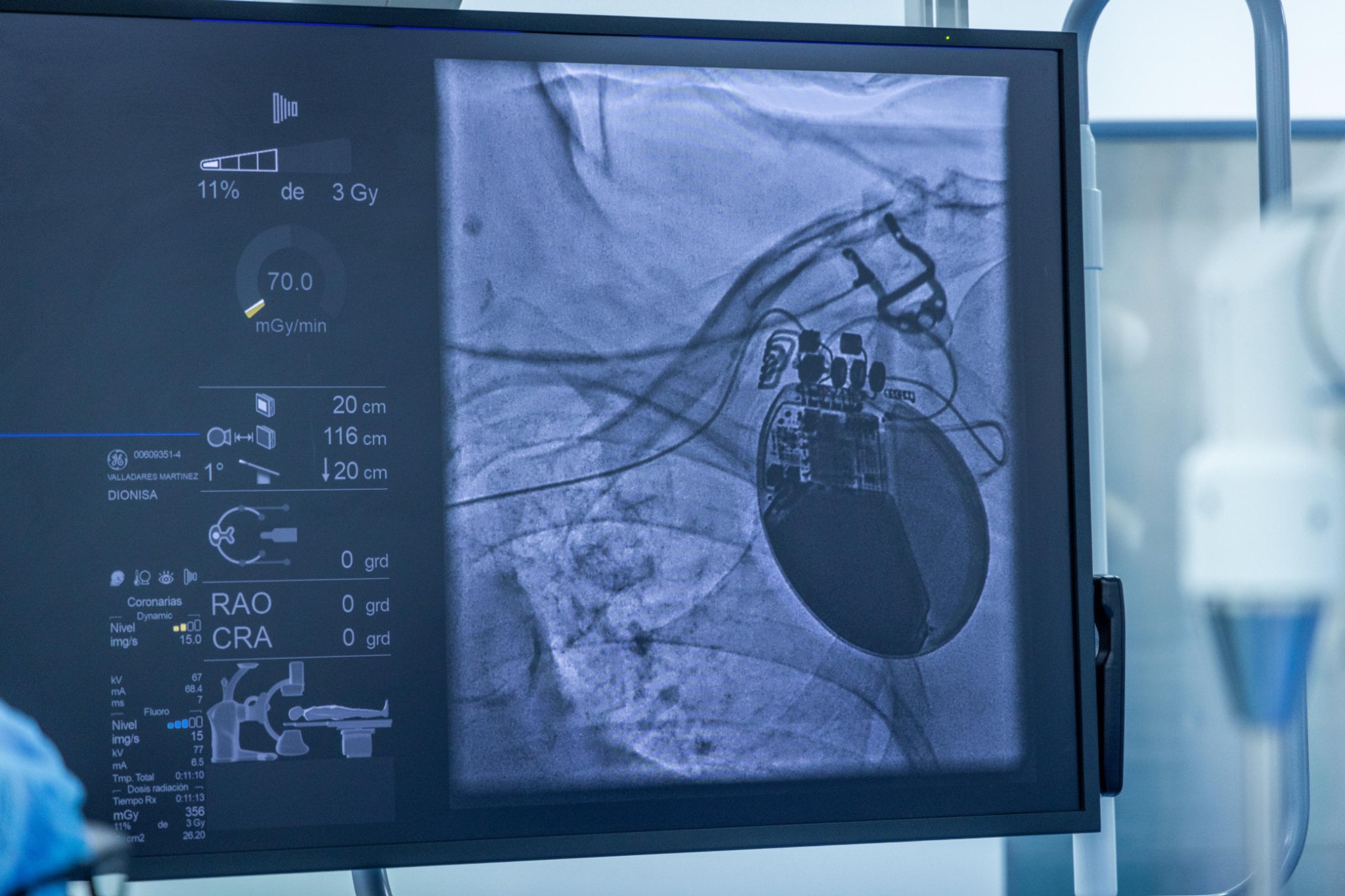 El Desfibrilador Automático Implantable permite detectar y corregir arritmias peligrosas en segundos en pacientes con riesgo de muerte súbita cardíaca./ (Nuevo Hospital Rosales)