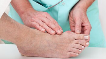 Los juanetes o dedos en