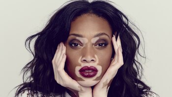 Winnie Harlow, la modelo que