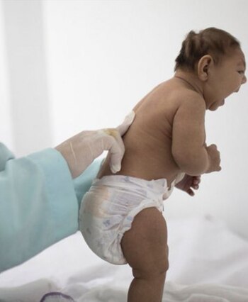 Niño con zika (AP)