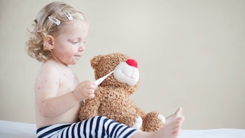 La primera señal de la enfermedad es la típica erupción en la piel que causa picazón (Shuttestock)