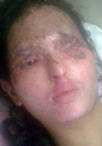 Así quedó el rostro de Reshma Qureshi luego del salvaje ataque con ácido de 2014 hecho por una banda de hombres