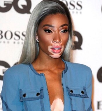 Winnie Harlow se hizo famosa