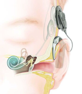 El procedimiento del implante puede