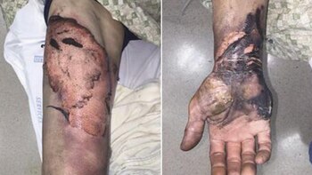 Los 15 pacientes tratados por