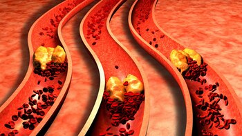 La obstrucción de una arteria provoca el grave problema de salud (Istock)