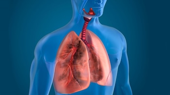 En la Argentina, la neumonía es la sexta causa de muerte en general y la quinta causa en mayores de 60 años (IStock)