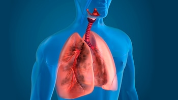 La neumonía es la sexta