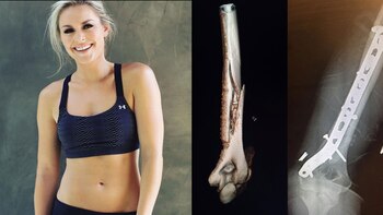 Lindsey Vonn ya había sufrido