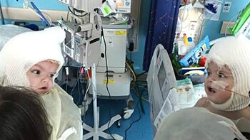 Jason y Anias, nacieron unidos