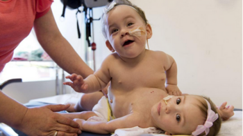 Las siamesas Erika y Eva