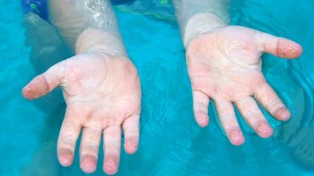 El arrugamiento es una reacción