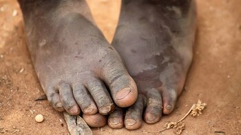 La pobreza acorta la vida mucho más que la hipertensión, la obesidad, y el consumo de alcohol en exceso (iStock)