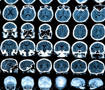 El parkinson afecta la coordinación