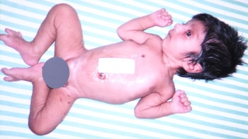 El recién nacido se recupera