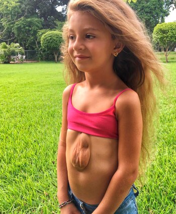 Virsaviya “Bathsheba” Borun-Goncharova, de siete años, sufre de síndrome torácico abdominal